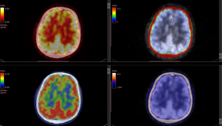 picture of pet scan image of brain